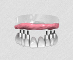 Bridge complet en céramique fixé sur 6 ou 8 implants dentaires.
